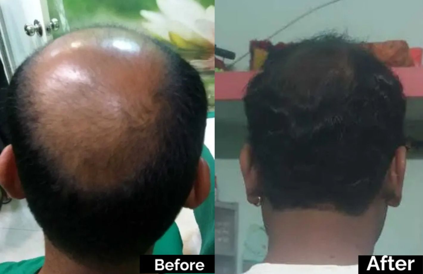 Hair Transplant (2)