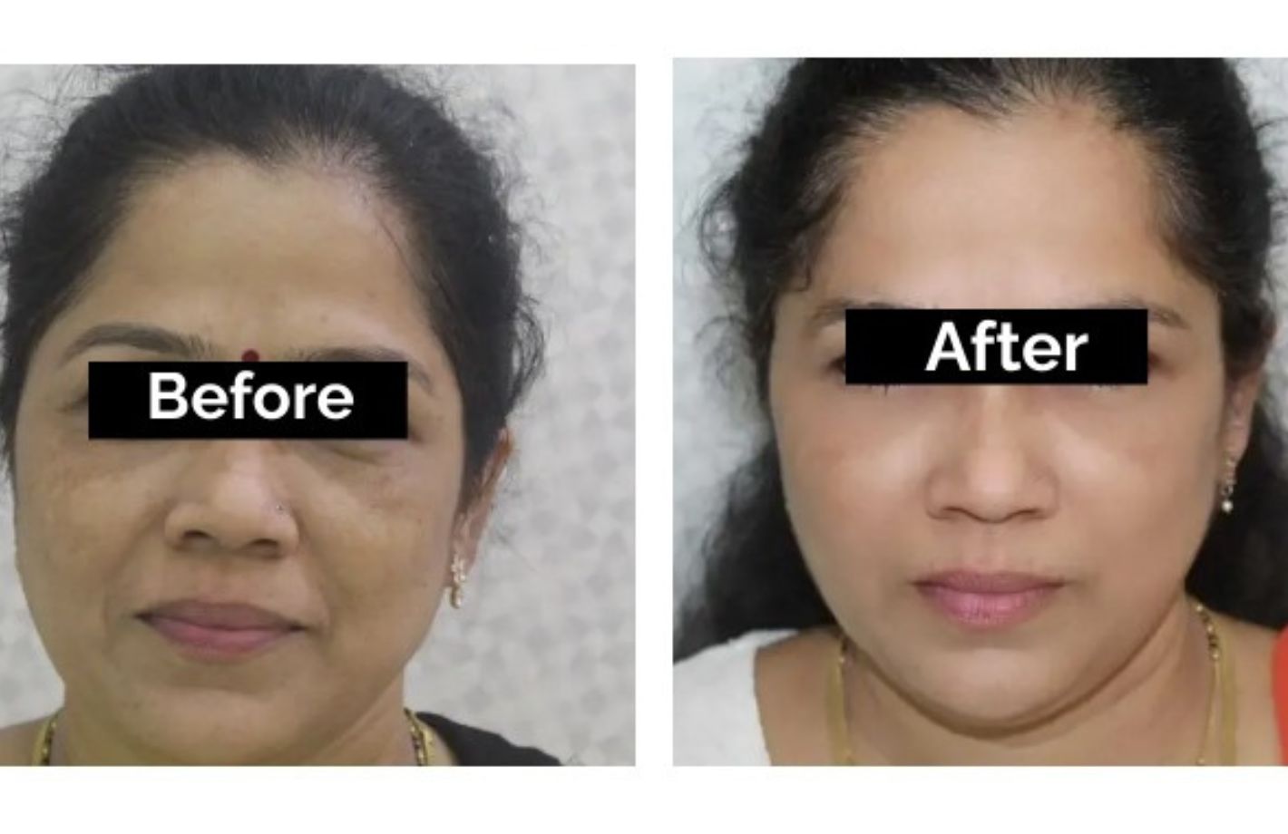 PIGMENTATION TREATMENT