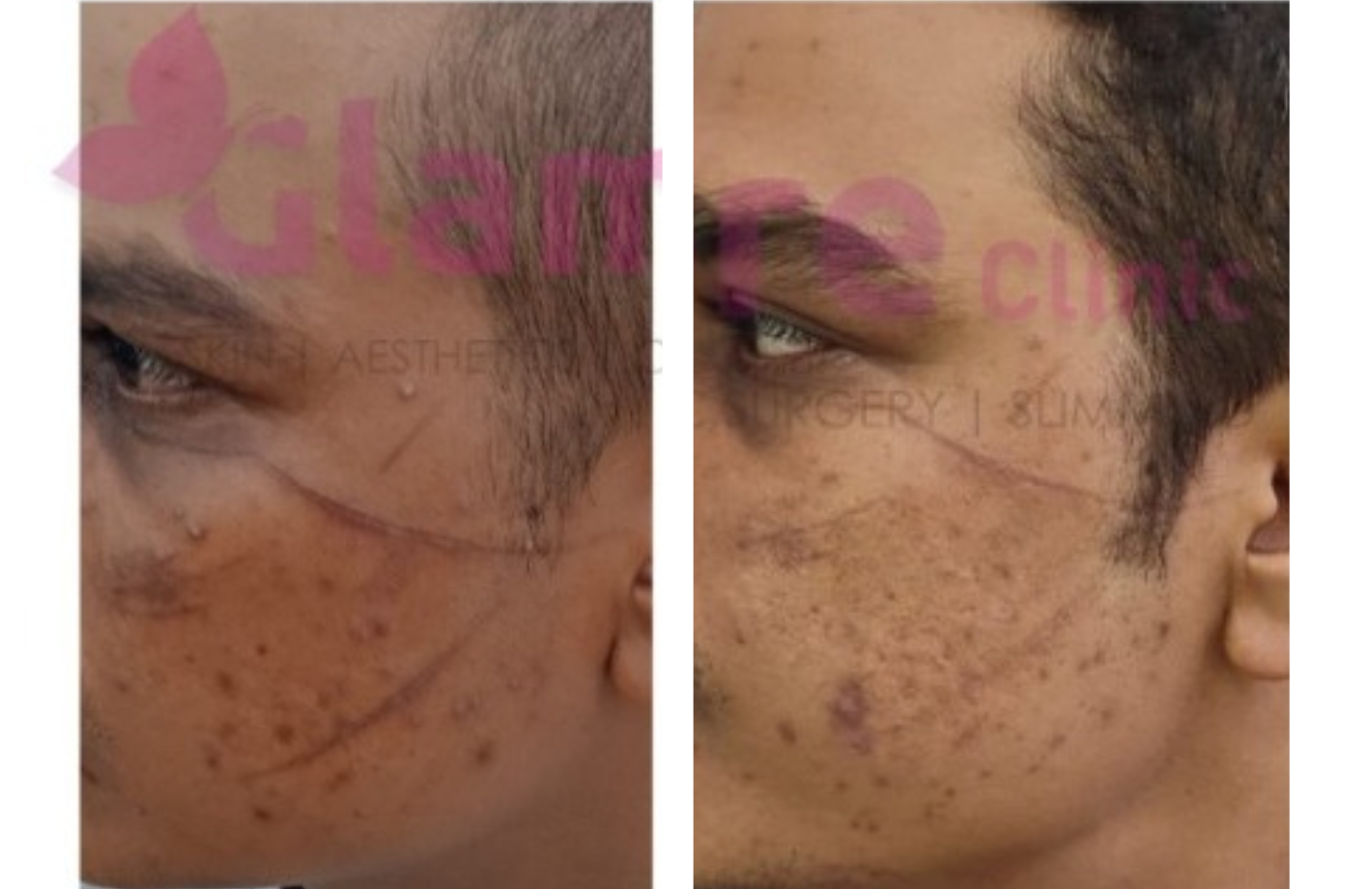 Scar Treatment (1)