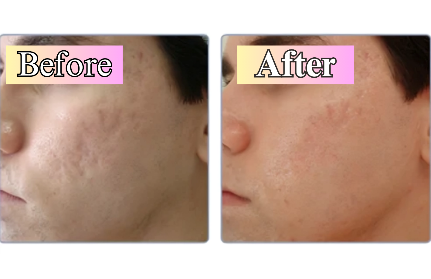 Scar Treatment (2)